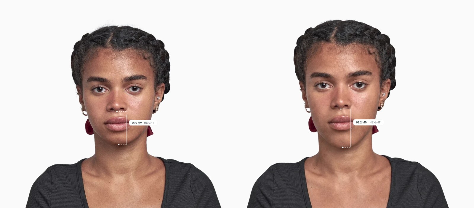 Two copies of the same female front-facing face with the lower face height drawn on each, the right one with a taller lower face Two copies of the same female front-facing face with the lower face height drawn on each, the right one with a taller lower face