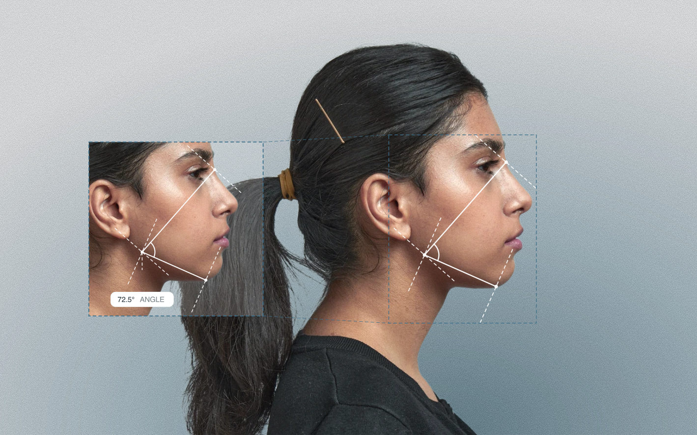 Lower gonial angle measured on a female side-profile portrait Lower gonial angle measured on a female side-profile portrait