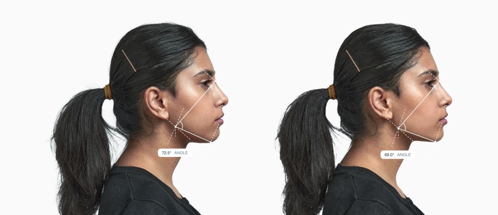 Two copies of the same female side-profile face with the lower gonial angle drawn on each, the right one with a reshaped lower jaw angle Two copies of the same female side-profile face with the lower gonial angle drawn on each, the right one with a reshaped lower jaw angle