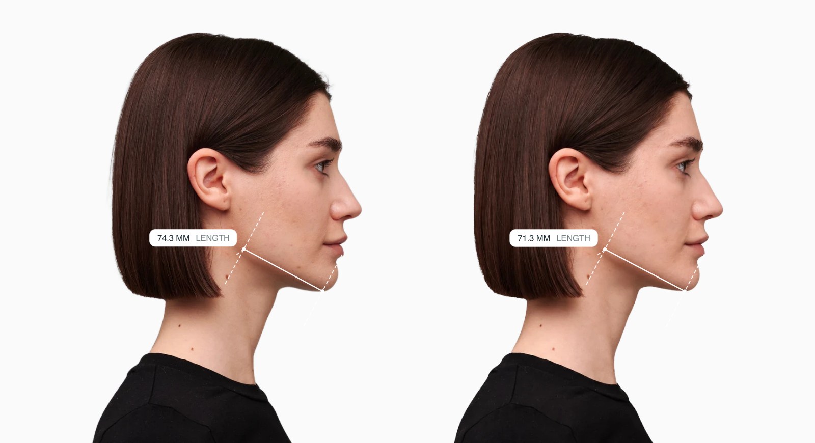 Two copies of the same female side-profile face with the mandible body length drawn on each, the right one with a reshaped lower jaw Two copies of the same female side-profile face with the mandible body length drawn on each, the right one with a reshaped lower jaw