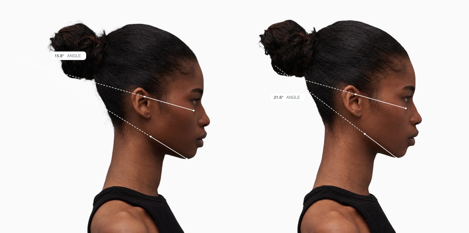 Two copies of the same female side-profile face with the mandibular plane angle drawn on each, the right one with a steeper jawline Two copies of the same female side-profile face with the mandibular plane angle drawn on each, the right one with a steeper jawline