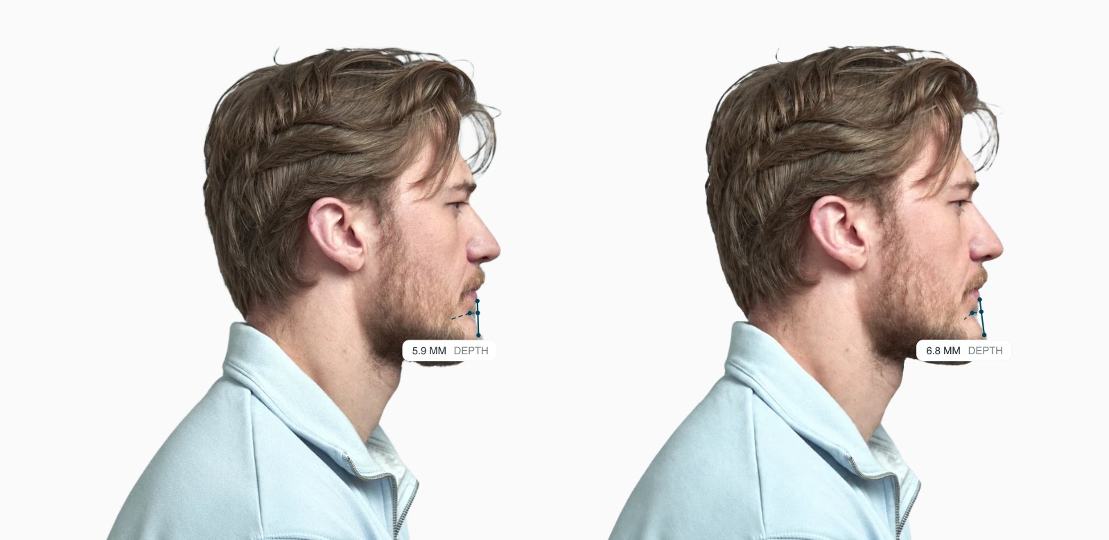 Two copies of the same male side-profile face with the mentolabial depth drawn on each, the right one with a deeper chin crease