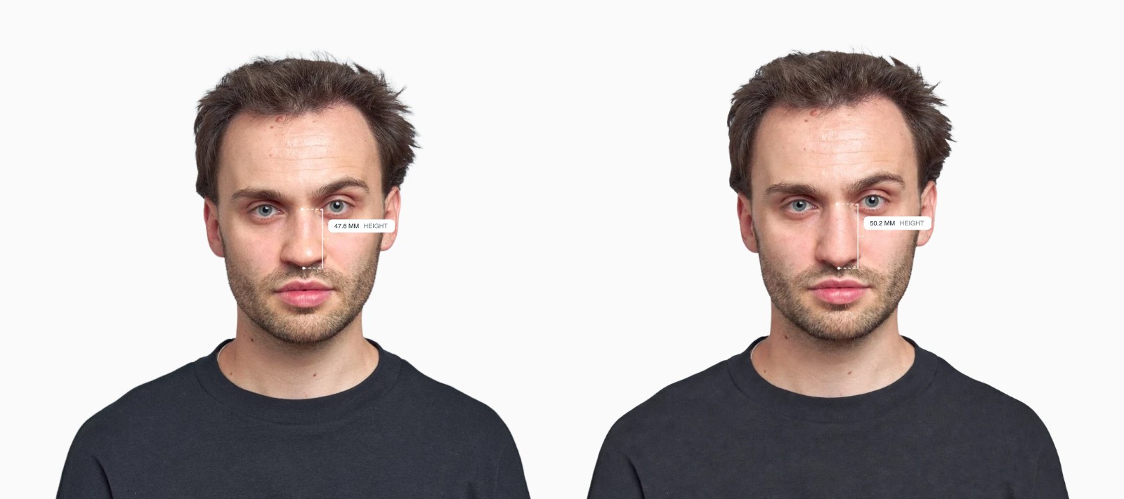 Two copies of the same male front-facing face with the nasal height drawn on each, the right one with a longer nose Two copies of the same male front-facing face with the nasal height drawn on each, the right one with a longer nose