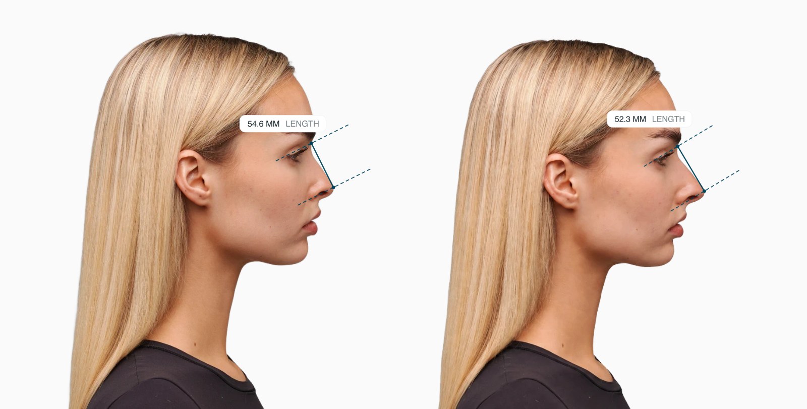 Two copies of the same female side-profile face with the nasal length drawn on each, the right one with a shorter nose