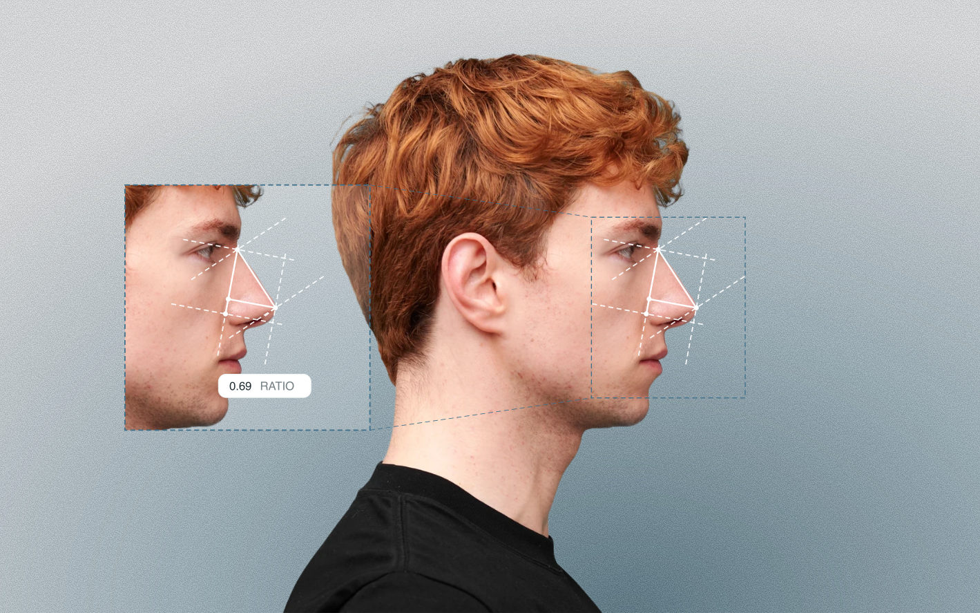 Nasal tip projection measured on a male side-profile portrait Nasal tip projection measured on a male side-profile portrait
