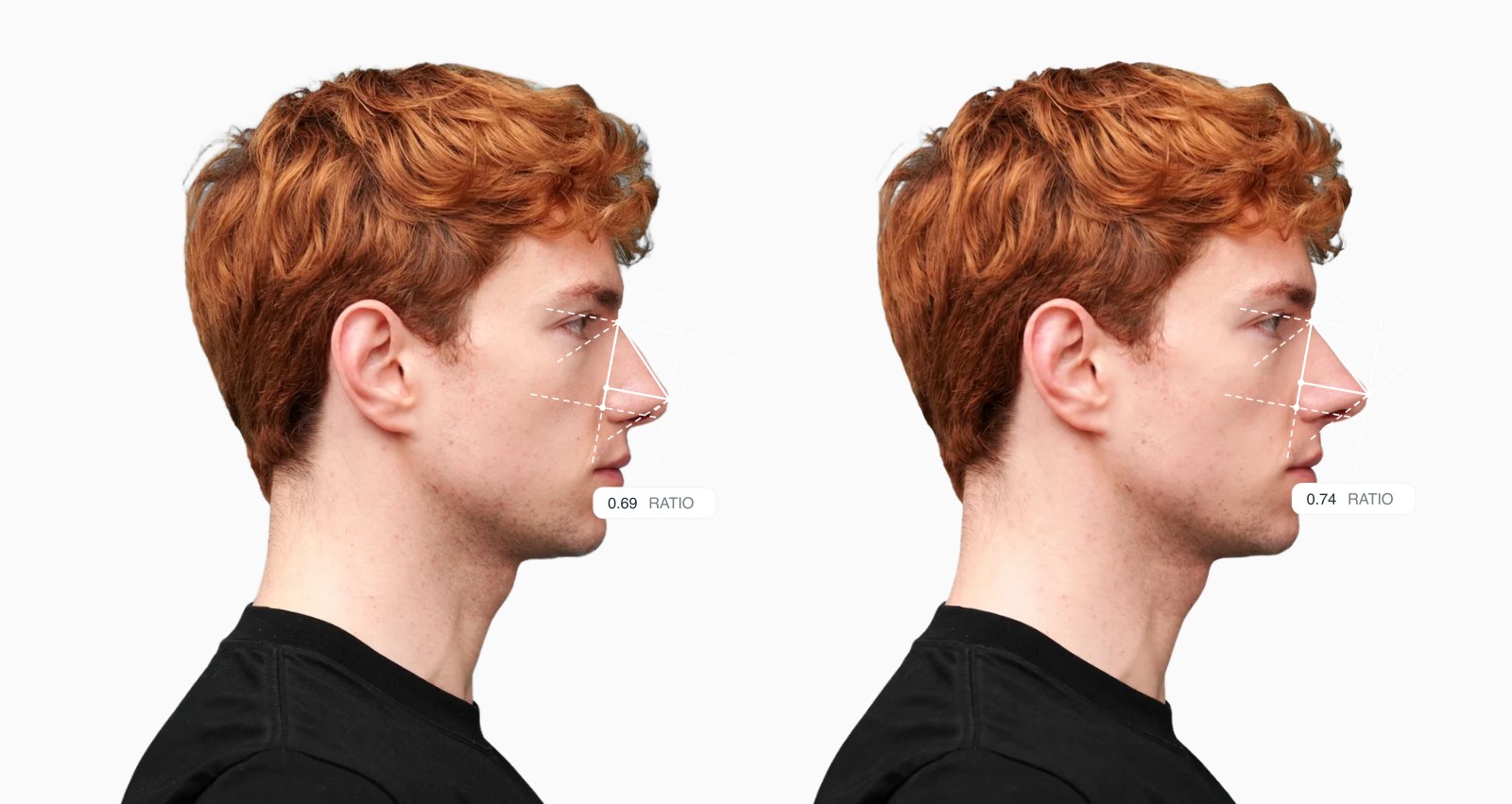 Two copies of the same male side-profile face with the nasal tip projection drawn on each, the right one with a more projected nasal tip Two copies of the same male side-profile face with the nasal tip projection drawn on each, the right one with a more projected nasal tip