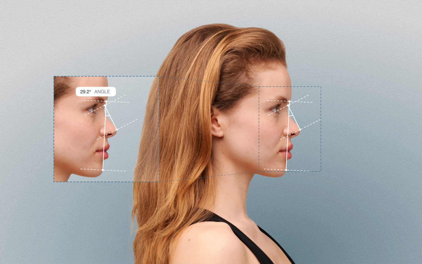 Nasofacial angle measured on a female side-profile portrait Nasofacial angle measured on a female side-profile portrait