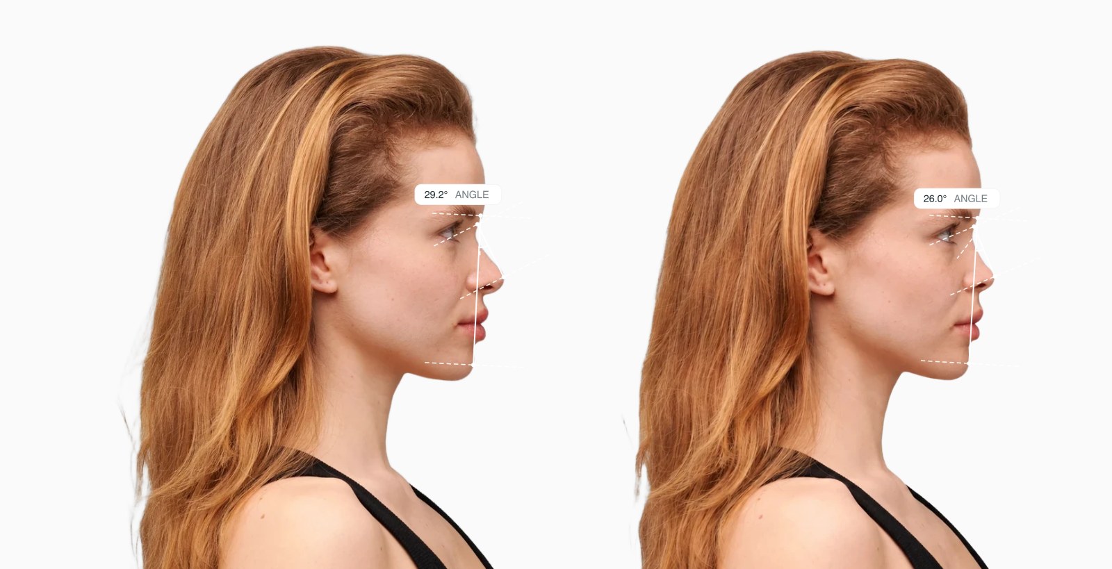 Two copies of the same female side-profile face with the nasofacial angle drawn on each, the right one with a less projected nose Two copies of the same female side-profile face with the nasofacial angle drawn on each, the right one with a less projected nose