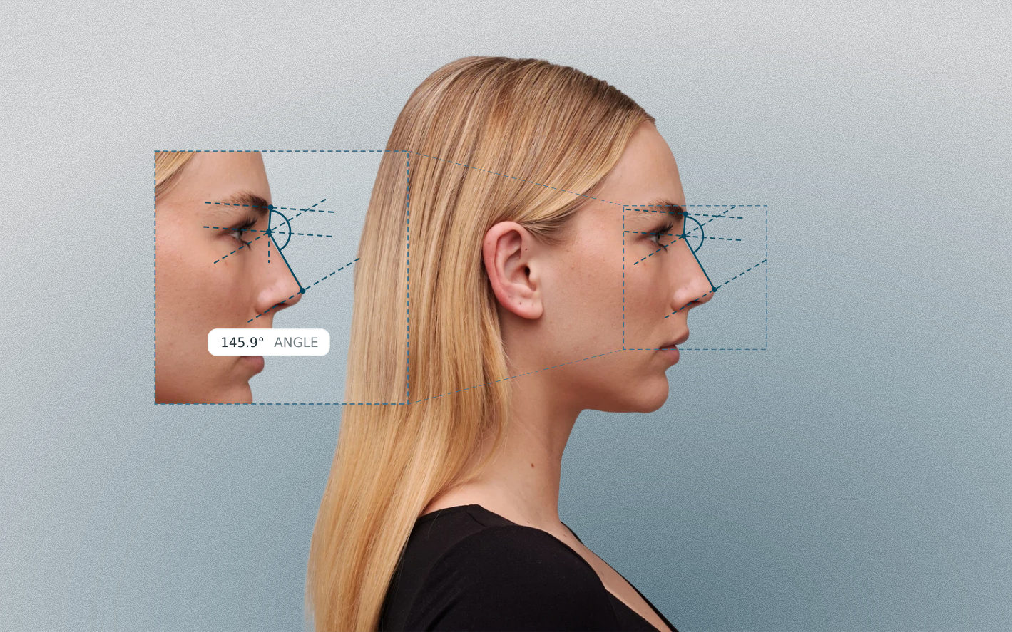 Nasofrontal angle measured on a female side-profile portrait Nasofrontal angle measured on a female side-profile portrait