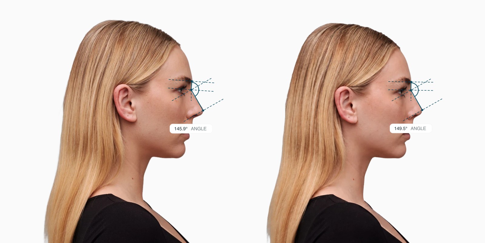 Two copies of the same female side-profile face with the nasofrontal angle drawn on each, the right one with a softer bridge at the brow Two copies of the same female side-profile face with the nasofrontal angle drawn on each, the right one with a softer bridge at the brow