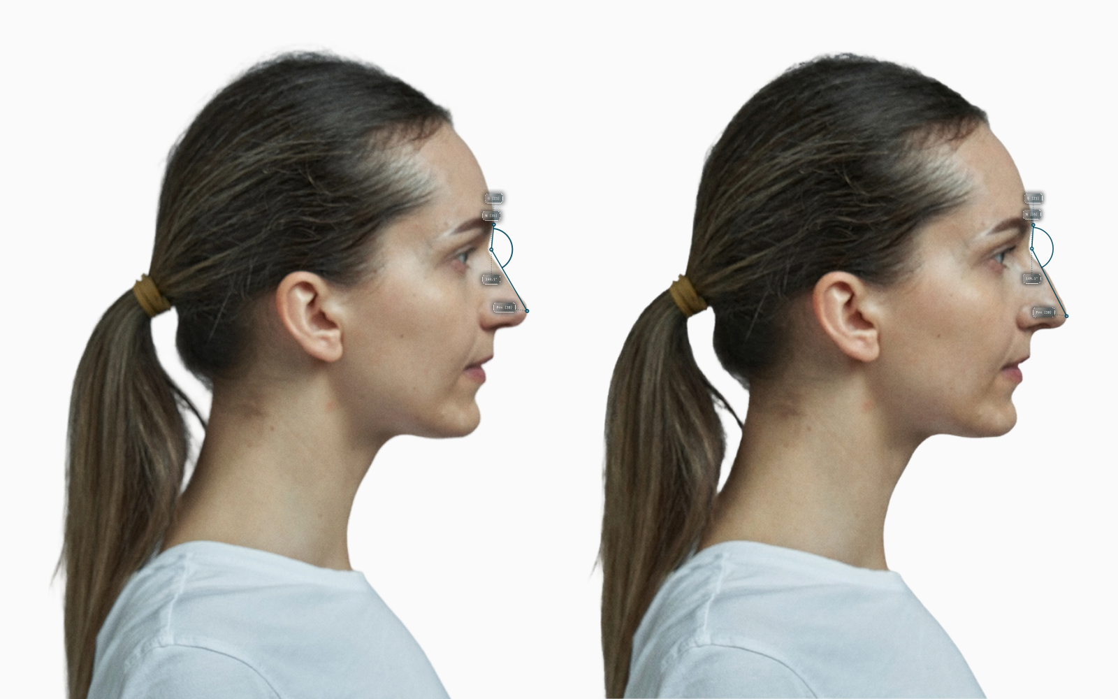 Female profile with dorsum raised, nasofrontal angle 144.1 to 141.5 degrees