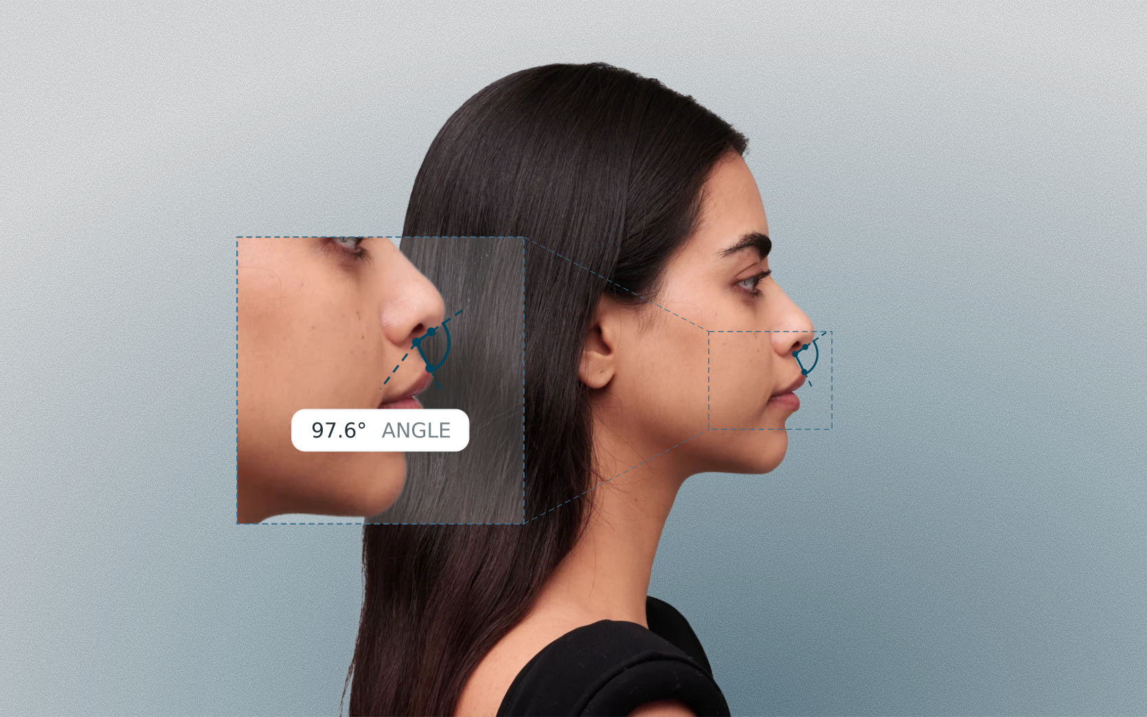 Nasolabial angle measured on a female side-profile portrait with magnified callout Nasolabial angle measured on a female side-profile portrait with magnified callout