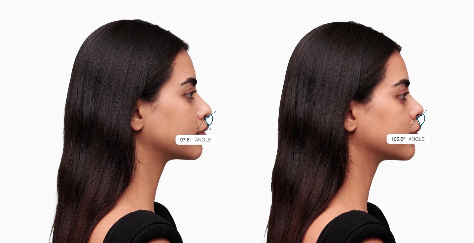 Female side profile before and after the nose tip is rotated up, with the nasolabial angle drawn on each Female side profile before and after the nose tip is rotated up, with the nasolabial angle drawn on each