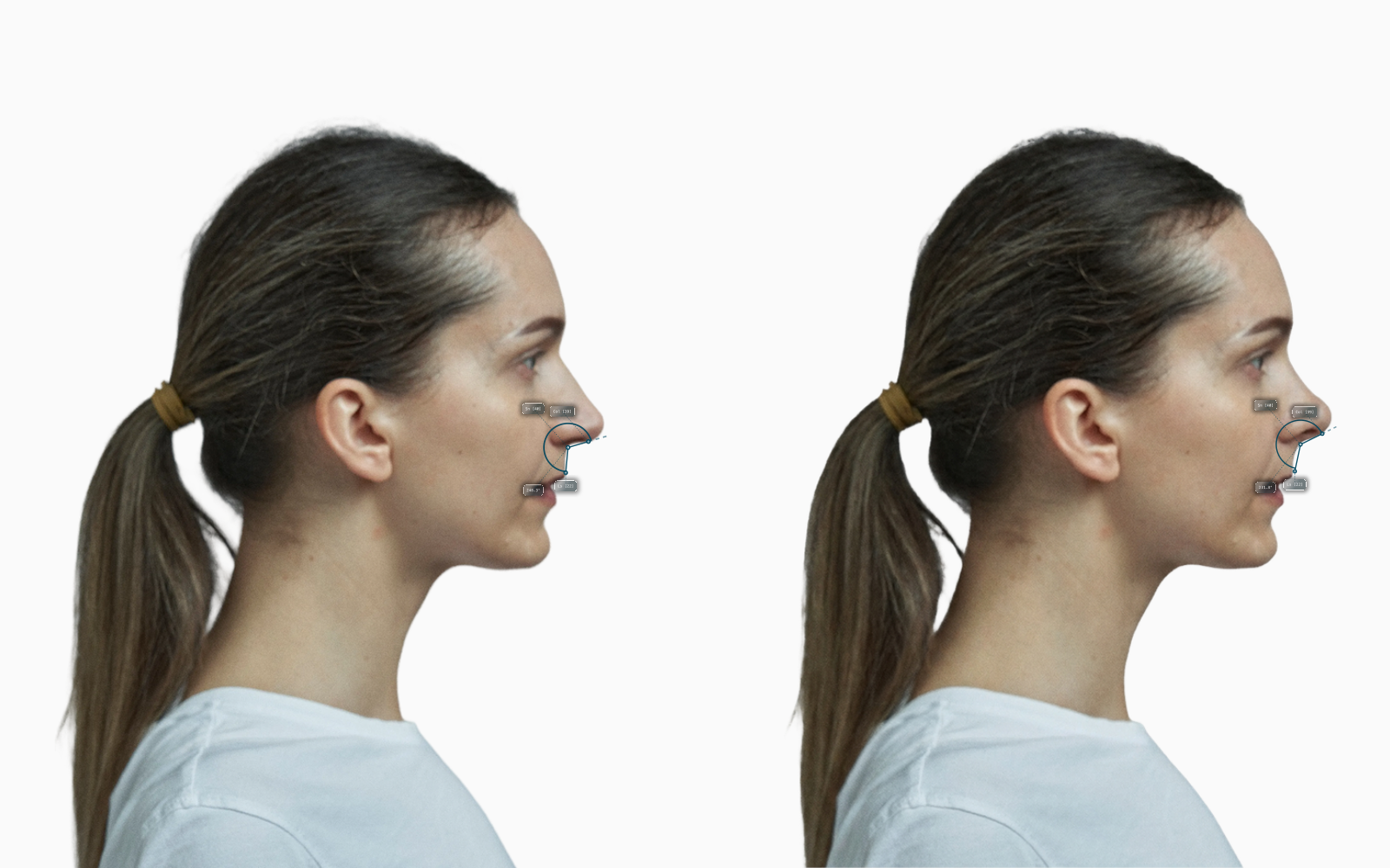 Nasolabial Angle before-and-after comparison on a female face, nose tip rotated upward by approximately 15 degrees