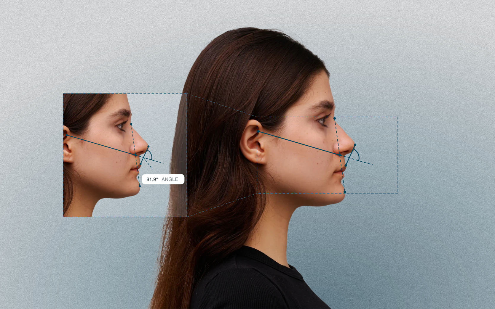 Nasomaxillary angle measured on a female side-profile portrait Nasomaxillary angle measured on a female side-profile portrait