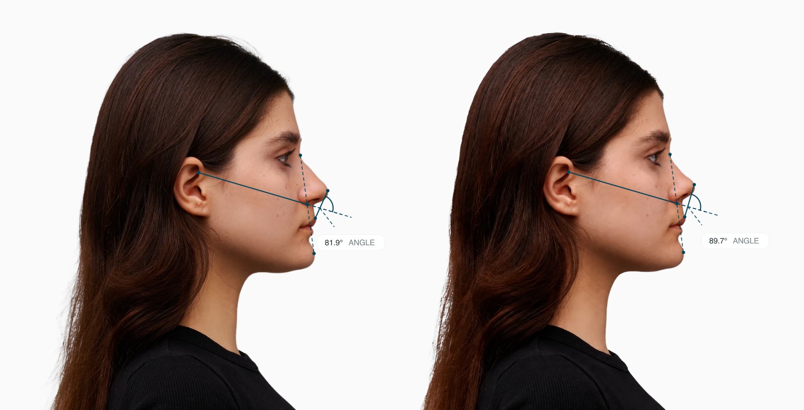 Two copies of the same female side-profile face with the nasomaxillary angle drawn on each, the right one with a lifted nasal base Two copies of the same female side-profile face with the nasomaxillary angle drawn on each, the right one with a lifted nasal base