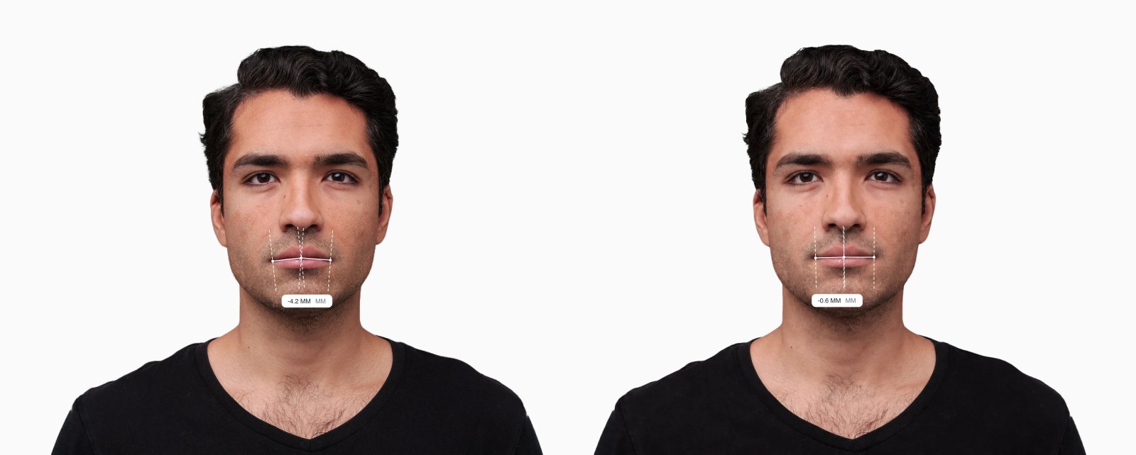 Two copies of the same male front-facing face with the oral commissure tilt drawn on each, the right one with upturned mouth corners Two copies of the same male front-facing face with the oral commissure tilt drawn on each, the right one with upturned mouth corners