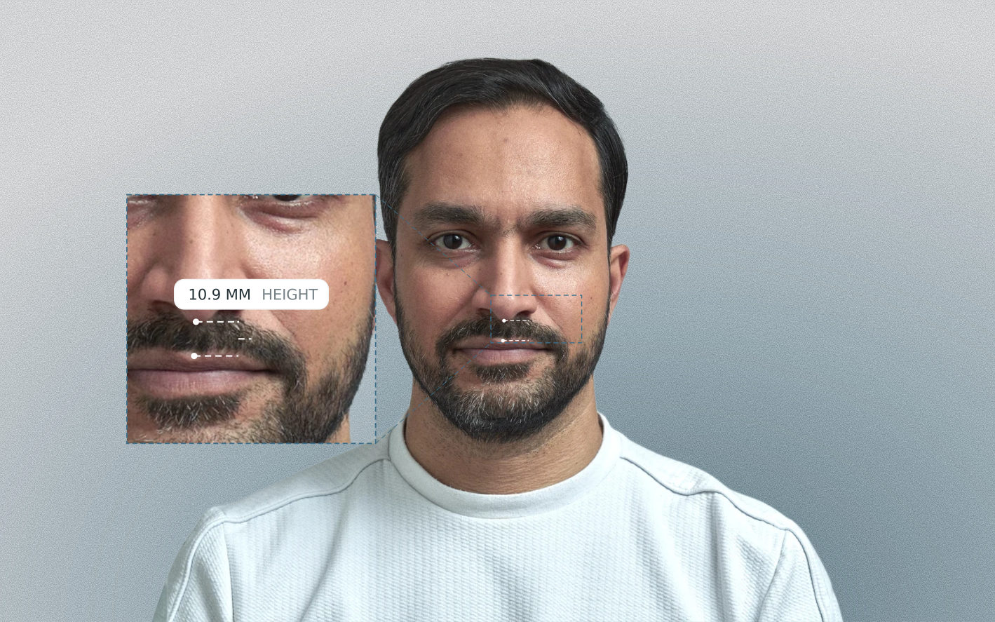 Philtrum length measured on a male front-facing portrait Philtrum length measured on a male front-facing portrait