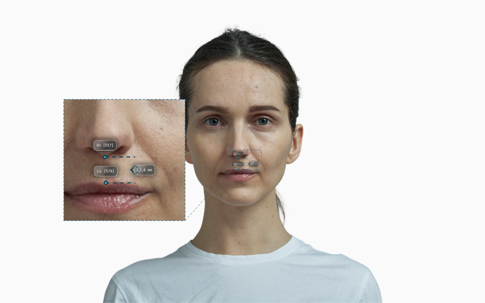 Philtrum length annotated on a female frontal portrait, Sn to Ls