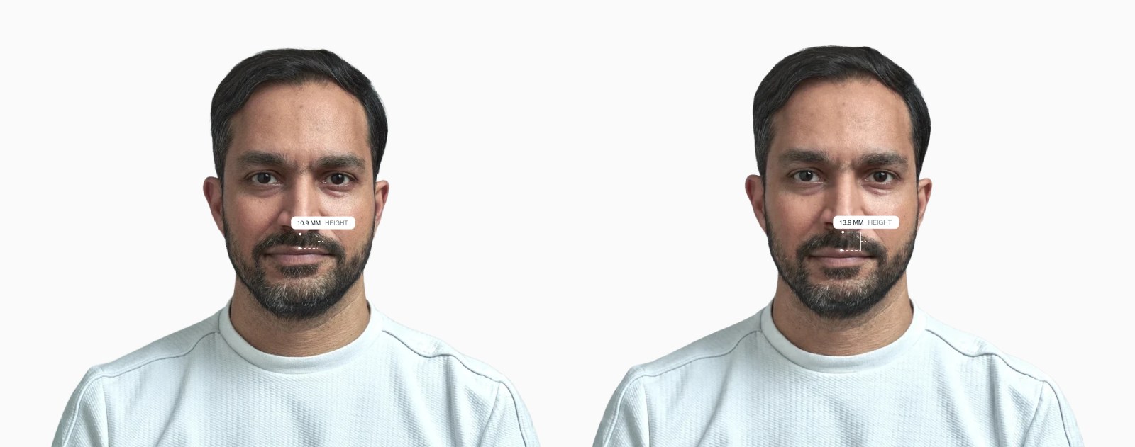 Two copies of the same male front-facing face with the philtrum length drawn on each, the right one with a longer philtrum Two copies of the same male front-facing face with the philtrum length drawn on each, the right one with a longer philtrum