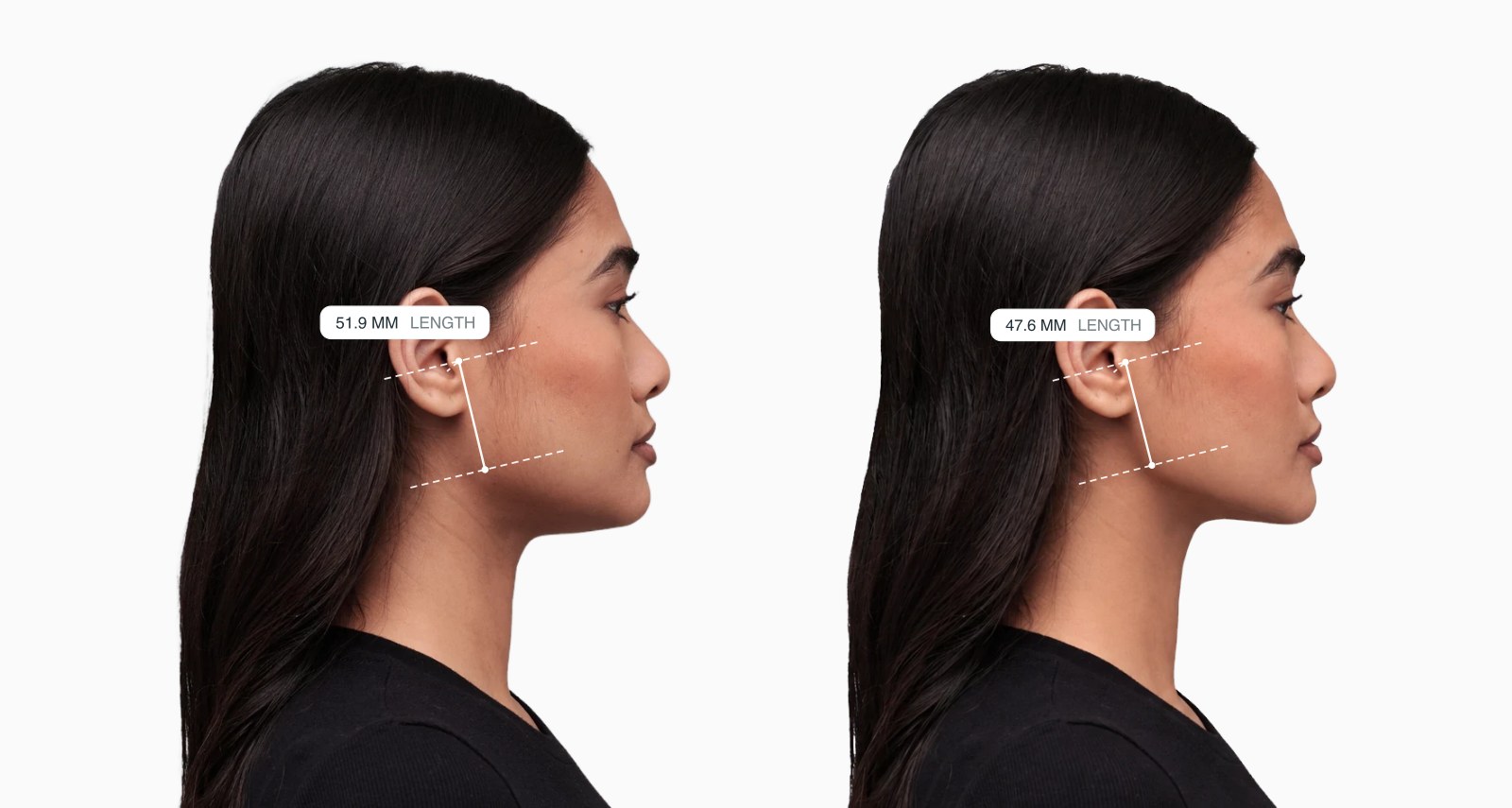 Two copies of the same female side-profile face with the ramus length drawn on each, the right one with a shorter back of the jaw Two copies of the same female side-profile face with the ramus length drawn on each, the right one with a shorter back of the jaw