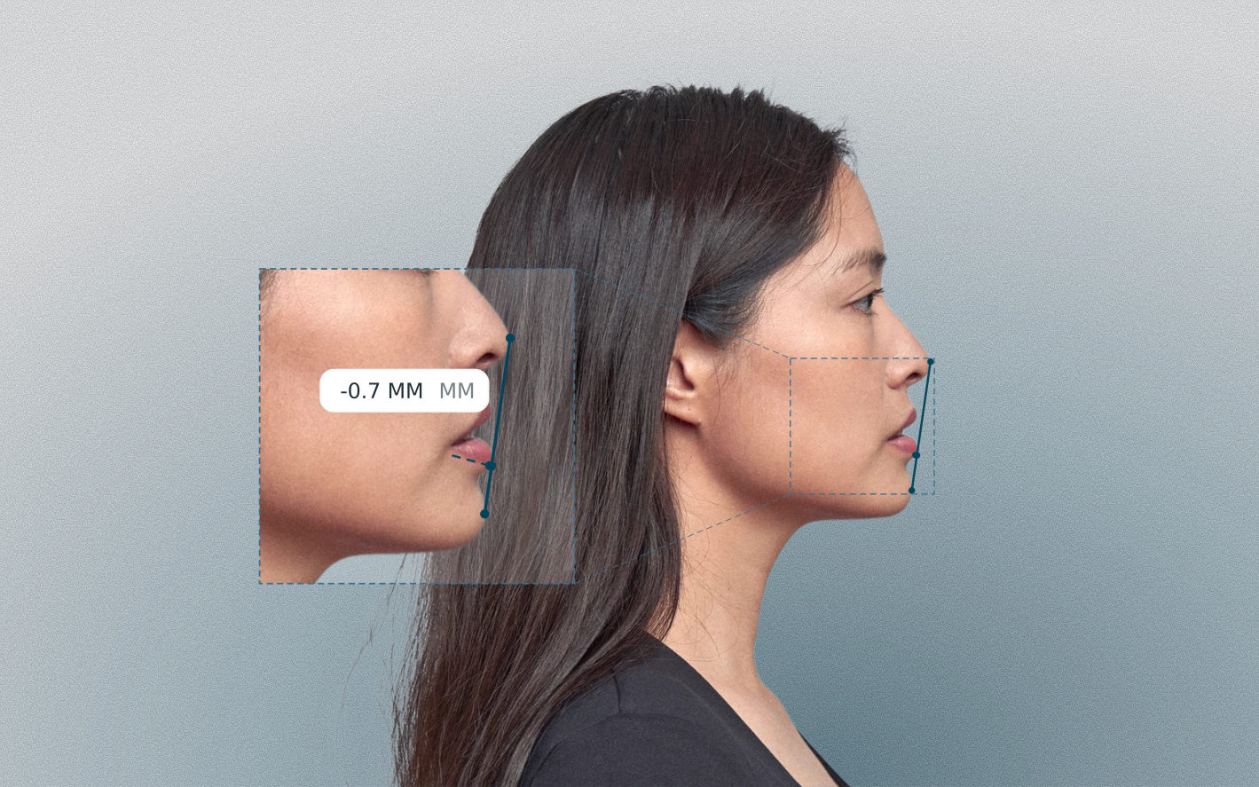 Ricketts E-line distance measured on a female side-profile portrait Ricketts E-line distance measured on a female side-profile portrait