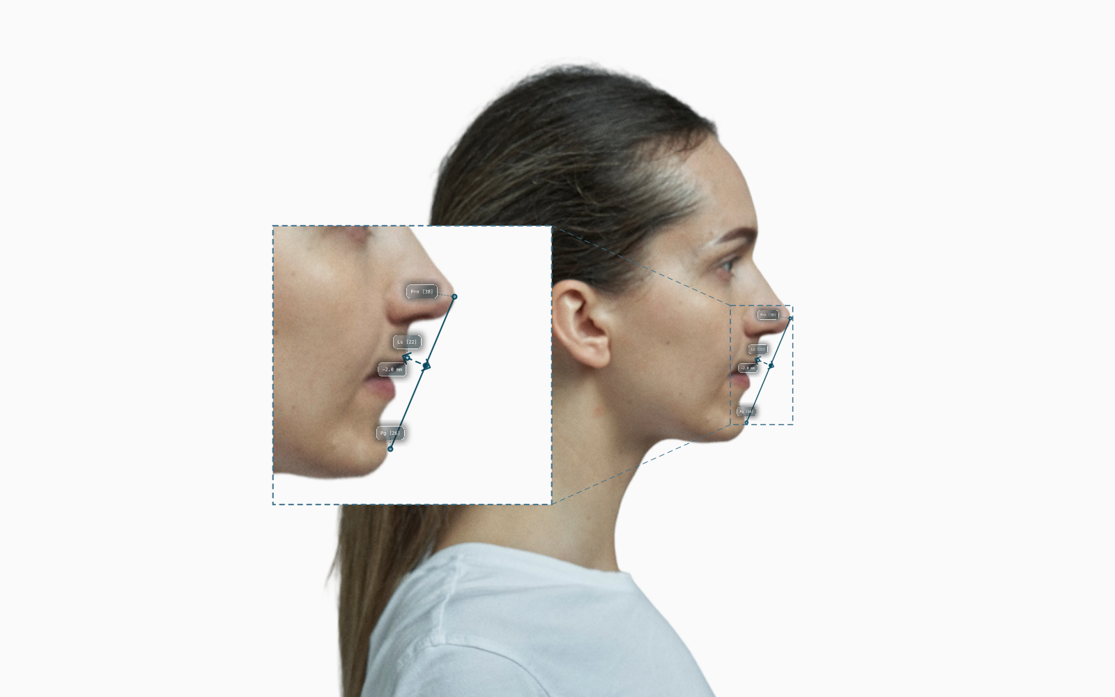 Ricketts E-line on a female profile, upper lip 2 mm behind the line