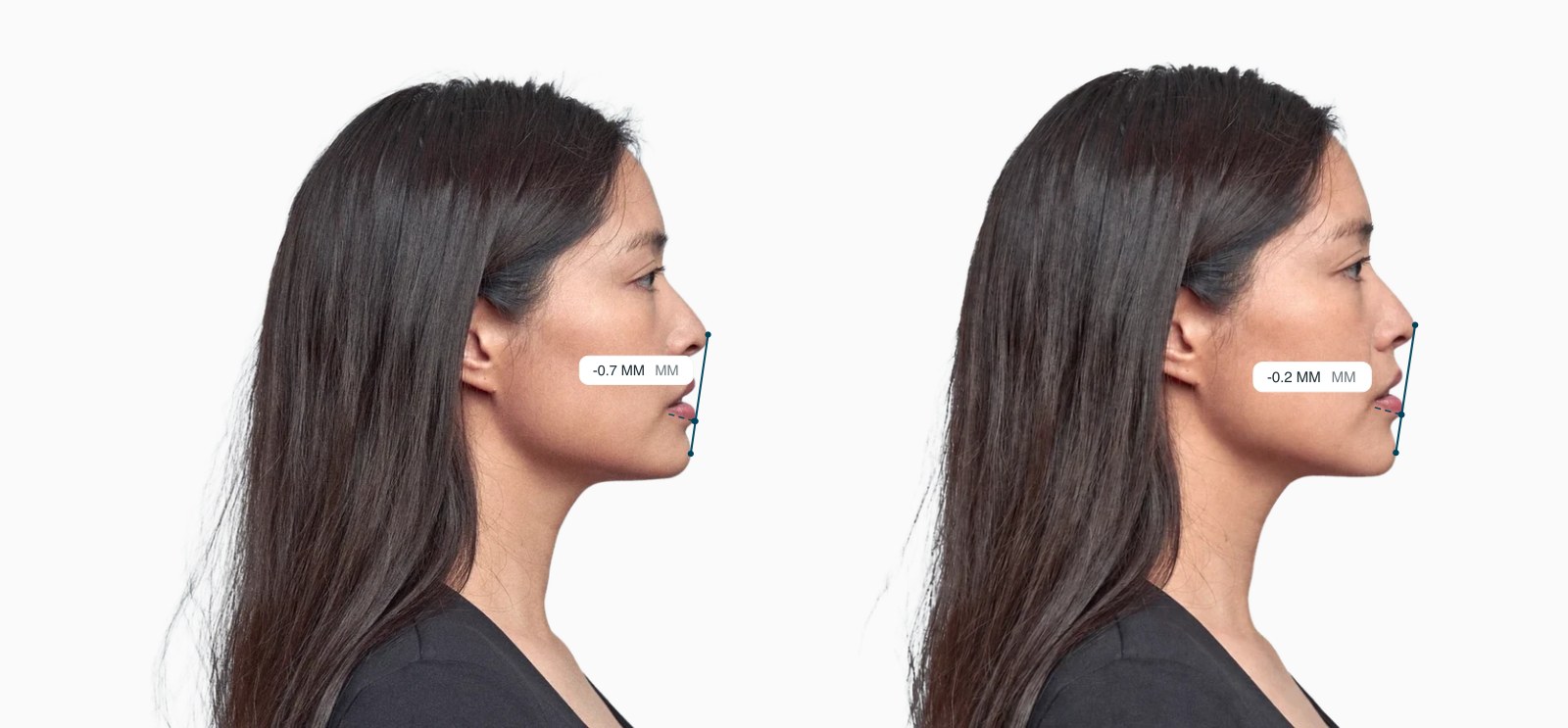 Two copies of the same female side-profile face with the Ricketts E-line distance drawn on each, the right one with fuller lips relative to the nose and chin Two copies of the same female side-profile face with the Ricketts E-line distance drawn on each, the right one with fuller lips relative to the nose and chin