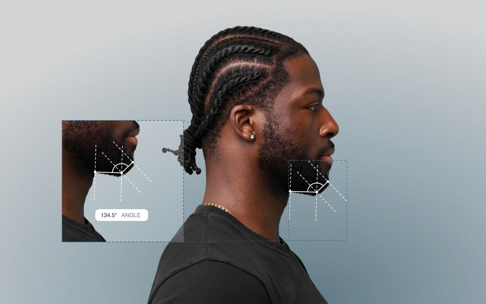 Submental angle measured on a male side-profile portrait Submental angle measured on a male side-profile portrait