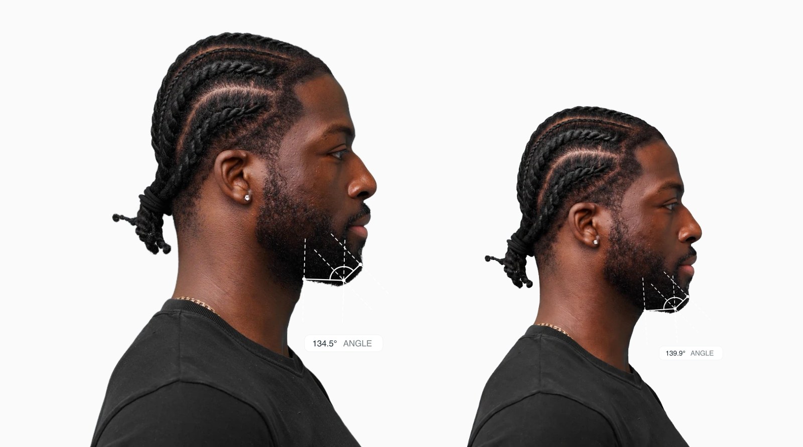 Two copies of the same male side-profile face with the submental angle drawn on each, the right one with a reshaped under-chin line Two copies of the same male side-profile face with the submental angle drawn on each, the right one with a reshaped under-chin line