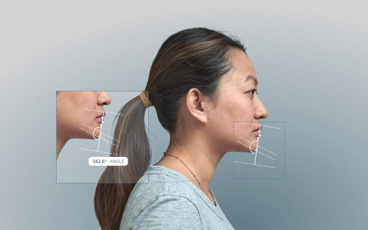 Submental cervical angle measured on a female side-profile portrait Submental cervical angle measured on a female side-profile portrait
