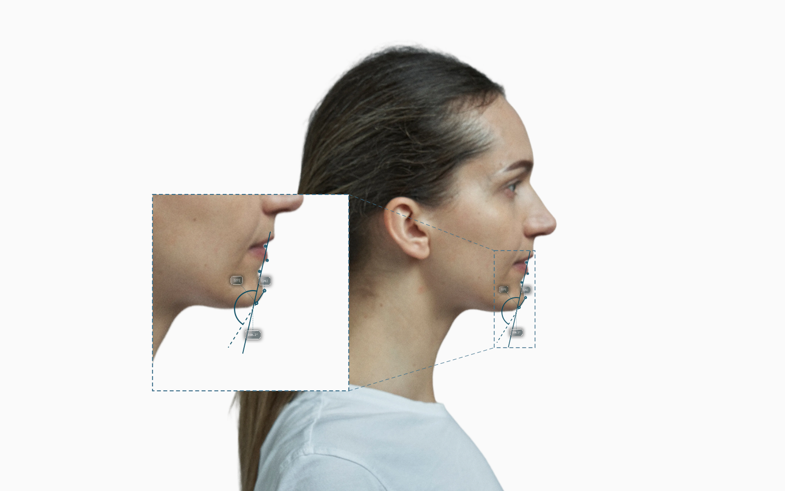 Submental-cervical angle annotated on a female right-profile portrait