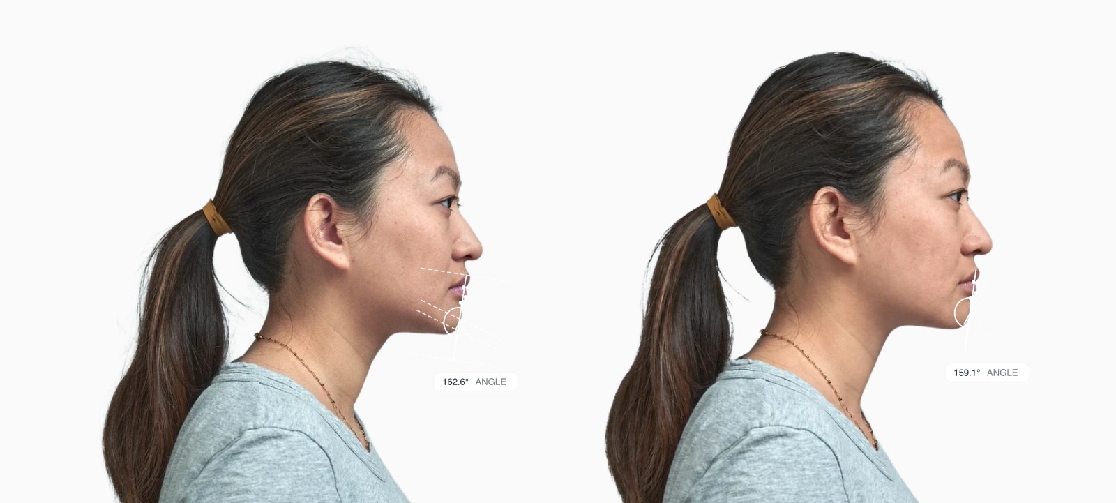 Two copies of the same female side-profile face with the submental cervical angle drawn on each, the right one with a sharper chin-to-neck angle Two copies of the same female side-profile face with the submental cervical angle drawn on each, the right one with a sharper chin-to-neck angle