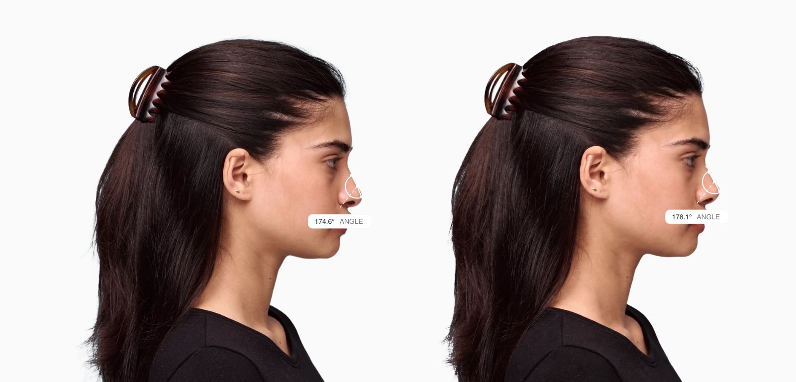 Two copies of the same female side-profile face with the supratip break angle drawn on each, the right one with a straighter nasal bridge above the tip Two copies of the same female side-profile face with the supratip break angle drawn on each, the right one with a straighter nasal bridge above the tip