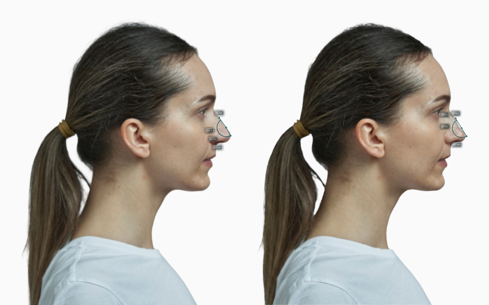 Supratip break angle before-and-after comparison on a female side-profile face