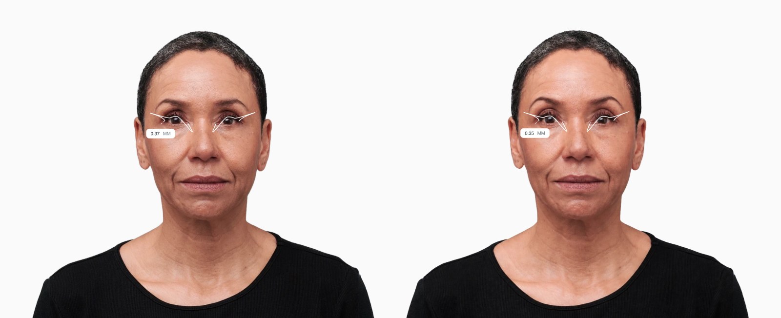 Two copies of the same female front-facing face with the upper eyelid curvature drawn on each, the right one with a flatter upper eyelid Two copies of the same female front-facing face with the upper eyelid curvature drawn on each, the right one with a flatter upper eyelid