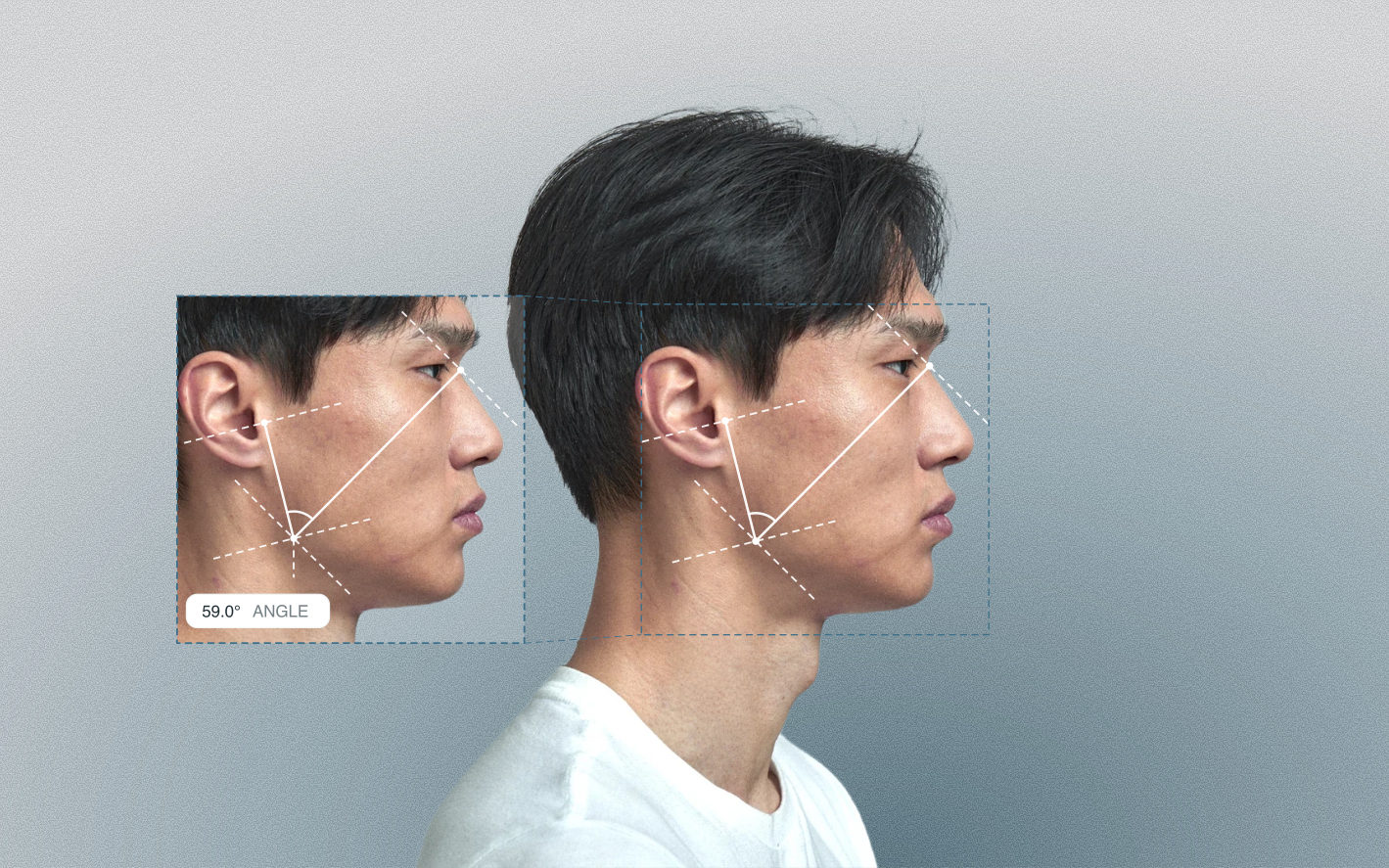 Upper gonial angle measured on a male side-profile portrait Upper gonial angle measured on a male side-profile portrait