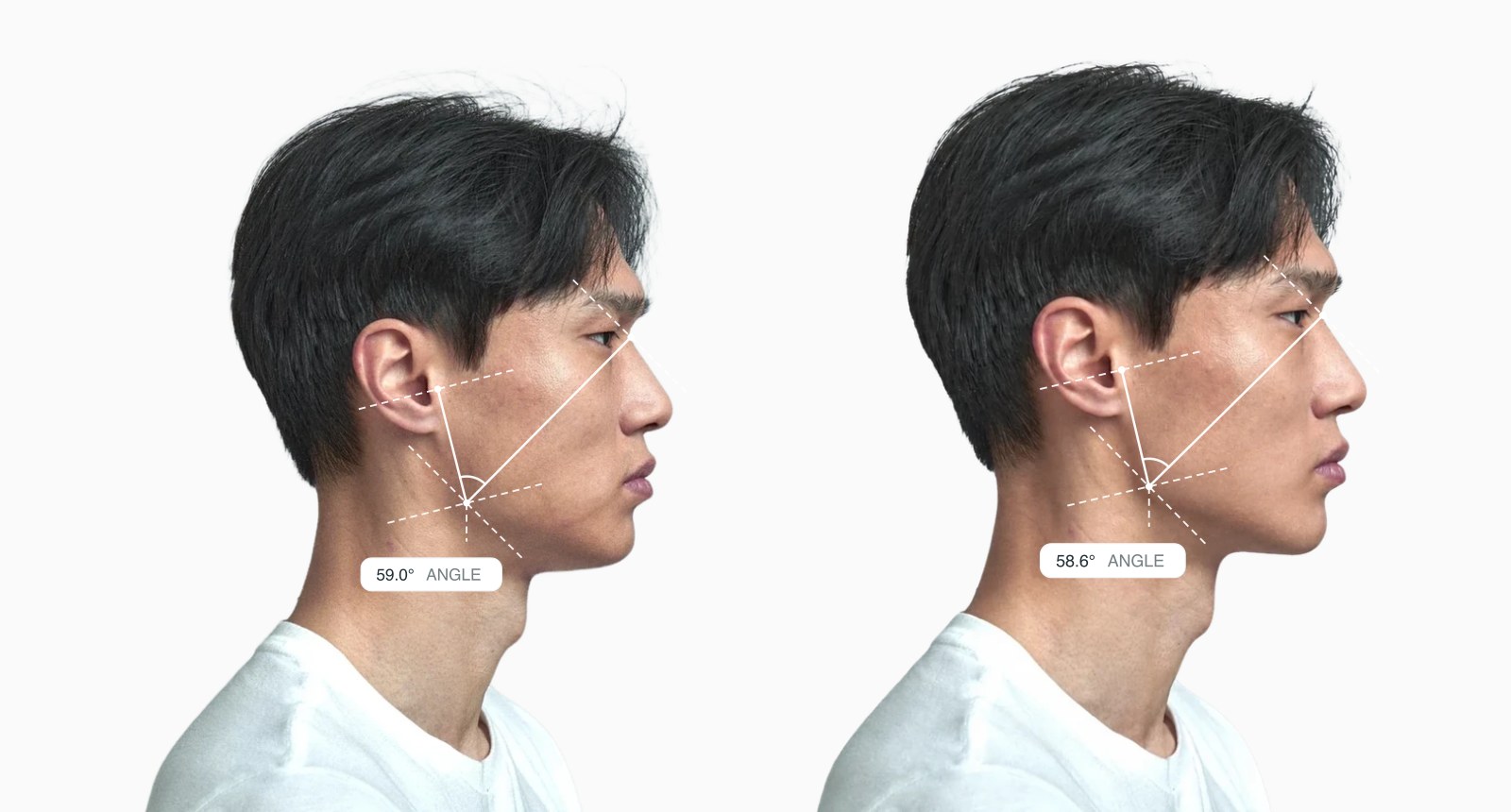 Two copies of the same male side-profile face with the upper gonial angle drawn on each, the right one with a slightly reshaped jaw Two copies of the same male side-profile face with the upper gonial angle drawn on each, the right one with a slightly reshaped jaw