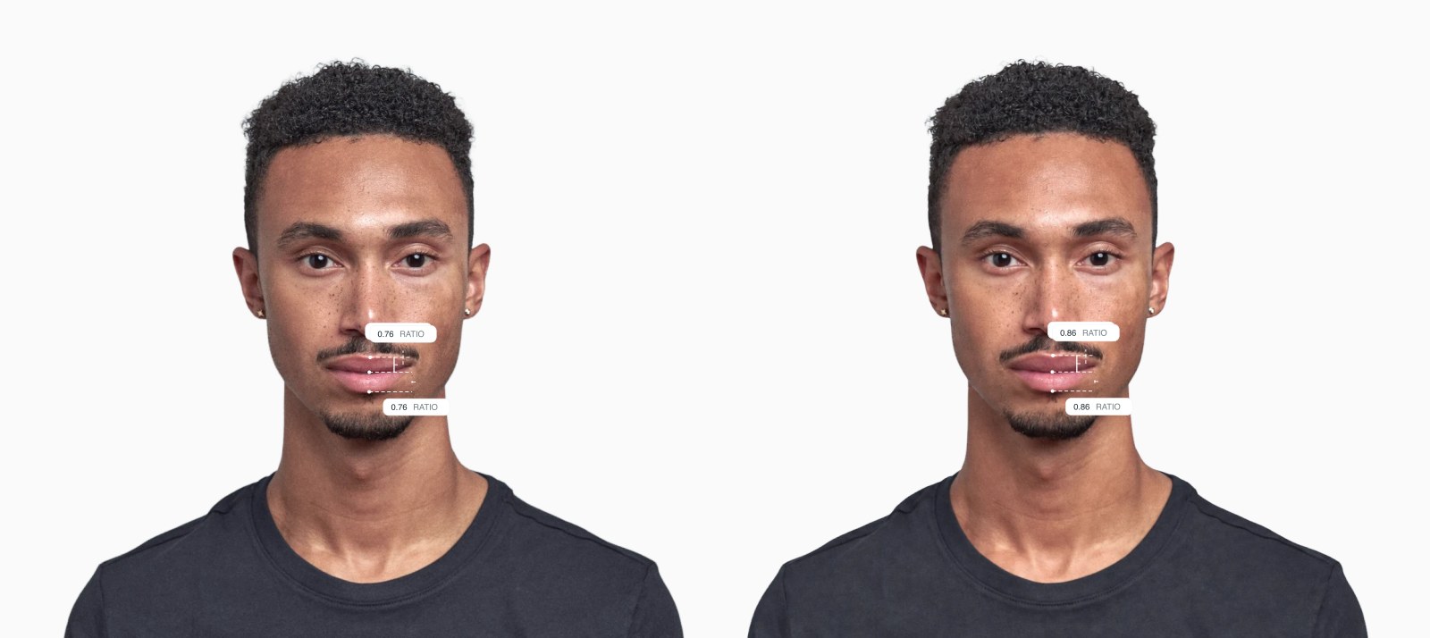 Two copies of the same male front-facing face with the upper-to-lower lip ratio drawn on each, the right one with a fuller upper lip Two copies of the same male front-facing face with the upper-to-lower lip ratio drawn on each, the right one with a fuller upper lip