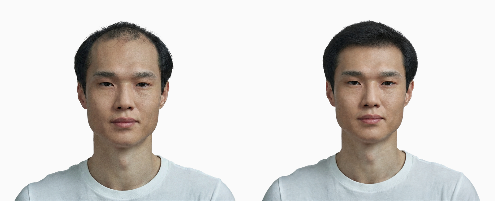 Male pattern hair loss before and after 12 months of medical treatment