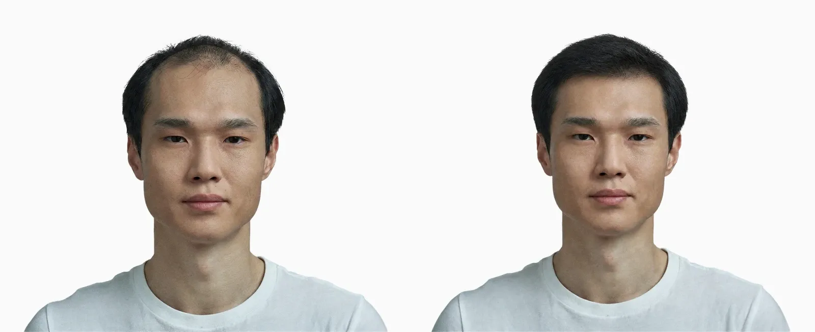 Male pattern hair loss before and after 12 months of medical treatment Male pattern hair loss before and after 12 months of medical treatment