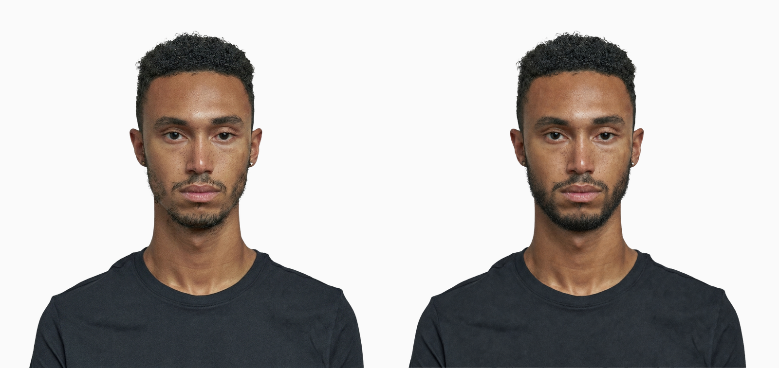 Patchy beard before and after 12 months of topical minoxidil application
