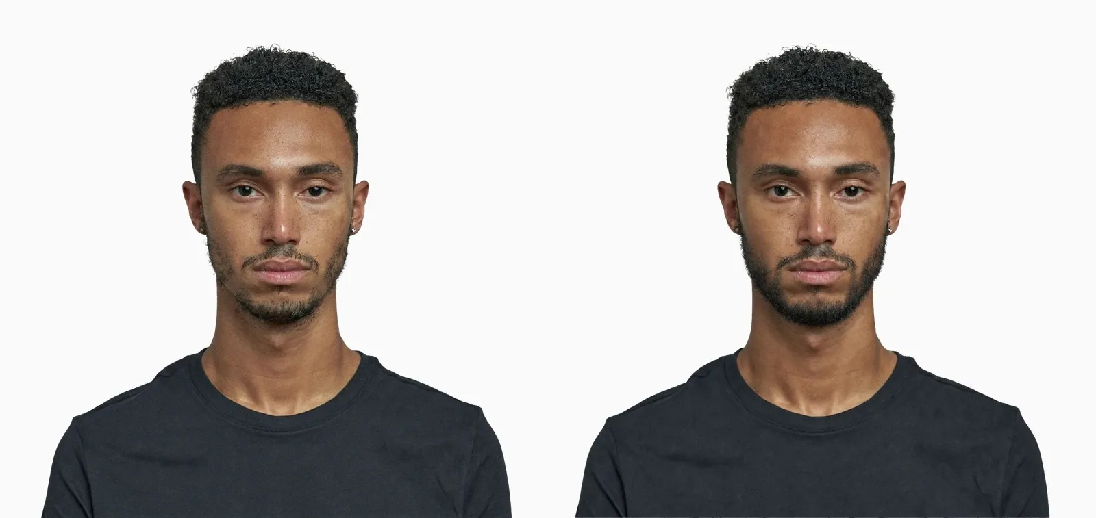 Patchy beard before and after 12 months of topical minoxidil application Patchy beard before and after 12 months of topical minoxidil application