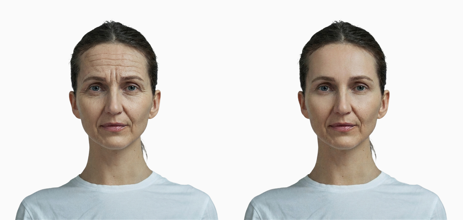 Forehead and frown lines before and after botulinum toxin injection on the same face