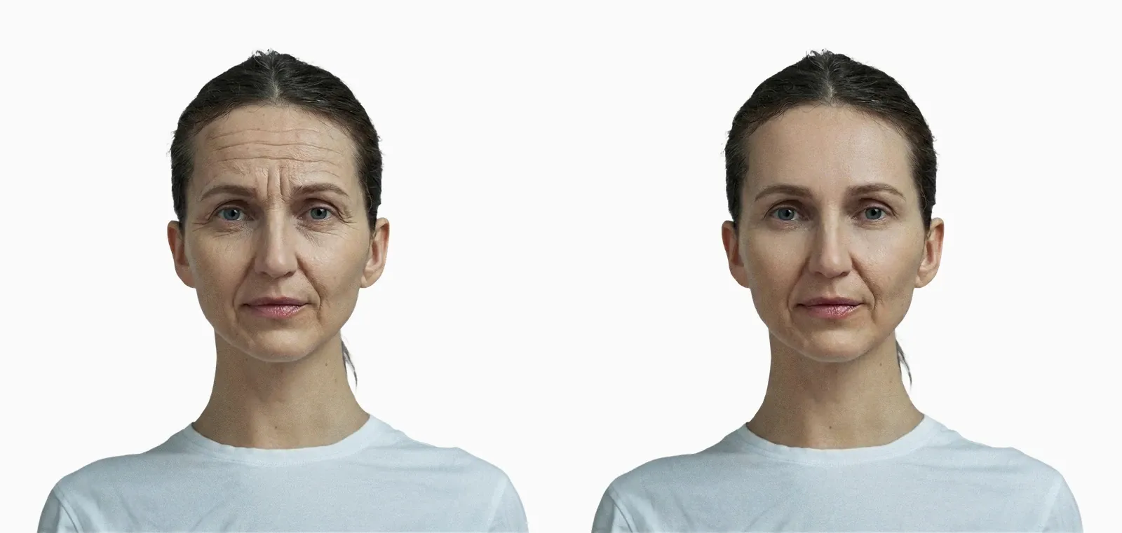 Forehead and frown lines before and after botulinum toxin injection on the same face Forehead and frown lines before and after botulinum toxin injection on the same face