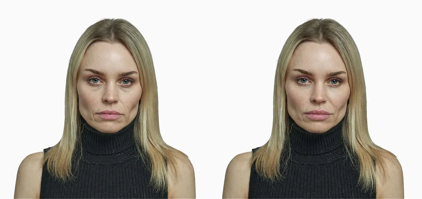 Mid-face volume loss before and after hyaluronic acid dermal filler treatment