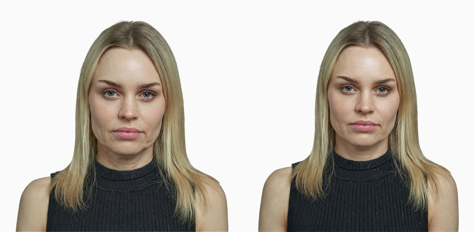 Crepey skin and mild laxity before and after Profhilo bio-remodelling treatment