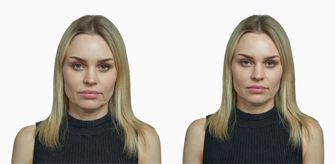 Crepey skin and mild laxity before and after Profhilo bio-remodelling treatment