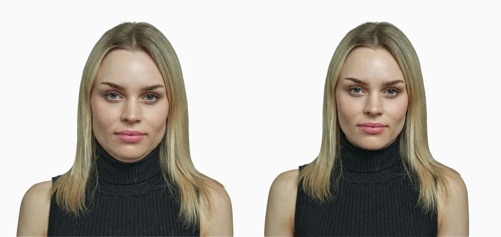 Submental fat reduction before and after CoolSculpting, with jawline definition restored Submental fat reduction before and after CoolSculpting, with jawline definition restored
