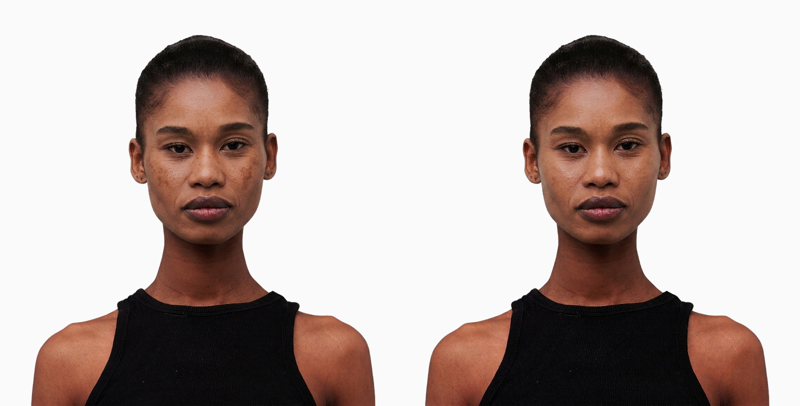 Sun-damaged skin texture and pigmentation before and after fractional laser resurfacing